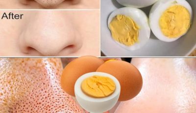 Say Goodbye to Blackheads with Just One Egg – Here’s How!