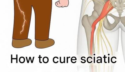 3 Exercises to Relieve Sciatica Pain in the Leg: Practical and Effective