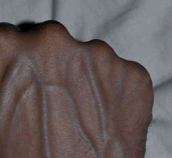 Visible Veins Explained: Normal Causes, Health Risks, and When to Worry