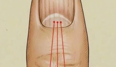 What to Eat to Reduce Nail Ridges: A Nutrition Guide for Healthier Nails
