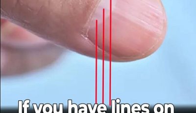 Doctor Uncovers A Telltale Sign In Your Fingernails That May Predict Your Life Expectancy