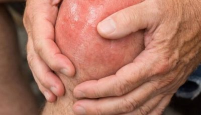 My Uncle Earl uses this simple 3 ingredient paste to completely erase his knee arthritis pain