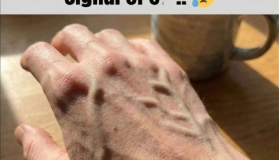 Visible Veins Explained: Normal Causes, Health Risks, and When to Worry