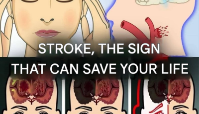Stroke: Here are the signs that can save your life.(1 / 2)