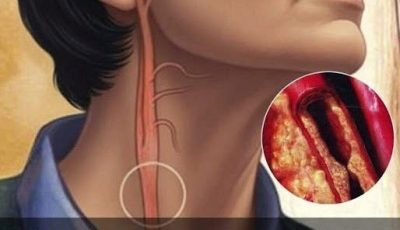 10 Indicators of Blocked Arteries You Shouldn’t Ignore