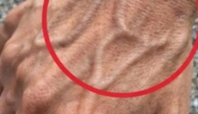 If Someone Has Visible Veins, Does It Mean Their Circulation Is Poor?