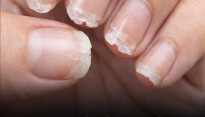 Weak or Brittle Nails: What Your Body Is Trying to Tell You