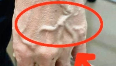 If Someone Has Visible Veins, Does It Mean Their Circulation Is Poor?