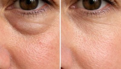 Place this 1 trick under your eyes and get rid of puffiness, swelling, and tired sagging skin
