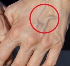 What the Veins on Your Hands Might Reveal About Your Kidney Health