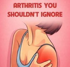 7 Signs of Arthritis You Shouldn’t Ignore