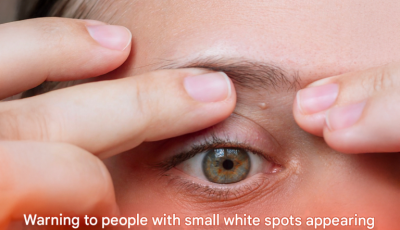 Warning to people with small white spots appearing all over their body: a doctor explains how to get rid of them