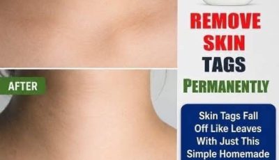 Skin Tags Warts Vaseline