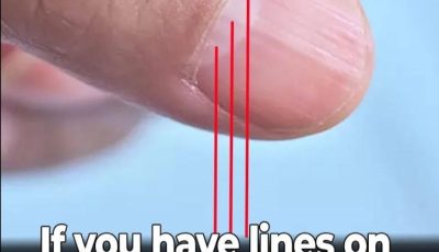 Doctor Uncovers A Telltale Sign In Your Fingernails That May Predict Your Life Expectancy