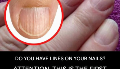 Here’s why you have vertical stripes or lines on your nails.(1 / 2)