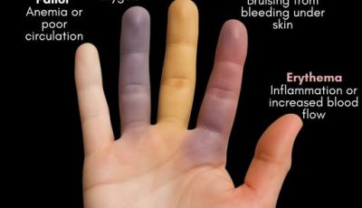 Your Skin Could Be Warning You About a Hidden Health Problem—Don’t Ignore These Signs