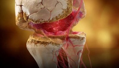 Top 3 Vitamins for Hip Arthritis