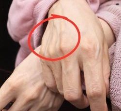 What Does It Mean to Have Visible Veins on Your Hands?