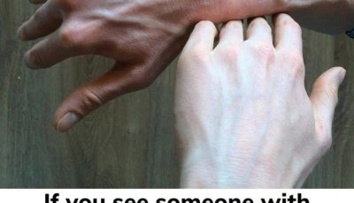 If you see someone with bulging veins, you must tell them these things